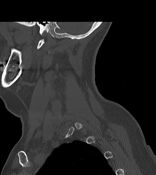 File:Chordoma (C4 vertebra) (Radiopaedia 47561-52188 Sagittal bone window 14).png