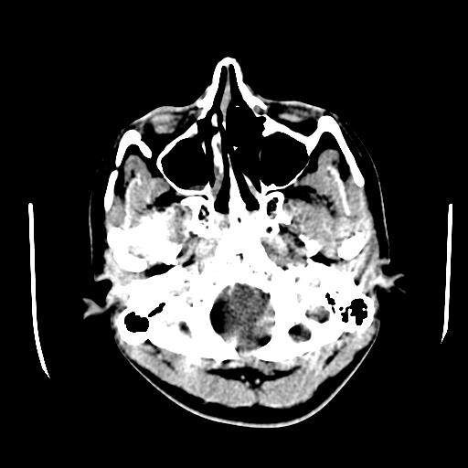 File:Choriocarcinoma of ovary with cerebral and pulmonary metastases (Radiopaedia 25983-26118 C+ arterial phase 7).jpg
