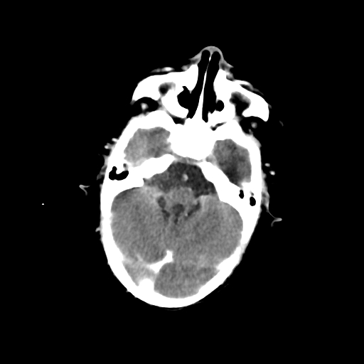 Choroid plexus papilloma (Radiopaedia 63946-72698 Axial with contrast 12).jpg
