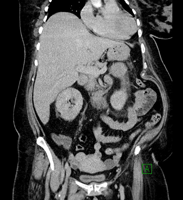Chromophobe renal cell carcinoma (Radiopaedia 84239-99519 F 40).jpg