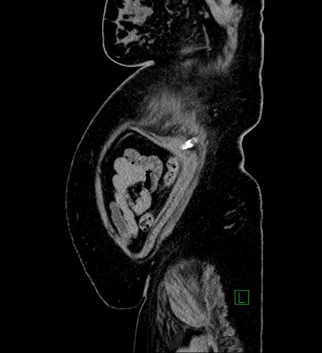 Chromophobe renal cell carcinoma (Radiopaedia 84239-99519 G 13).jpg