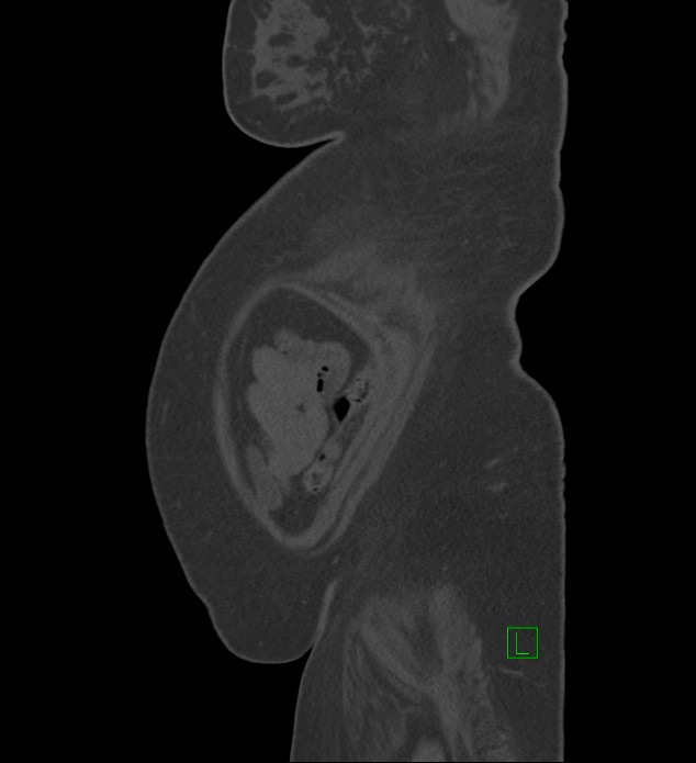 Chromophobe renal cell carcinoma (Radiopaedia 84239-99519 Sagittal bone window 4).jpg