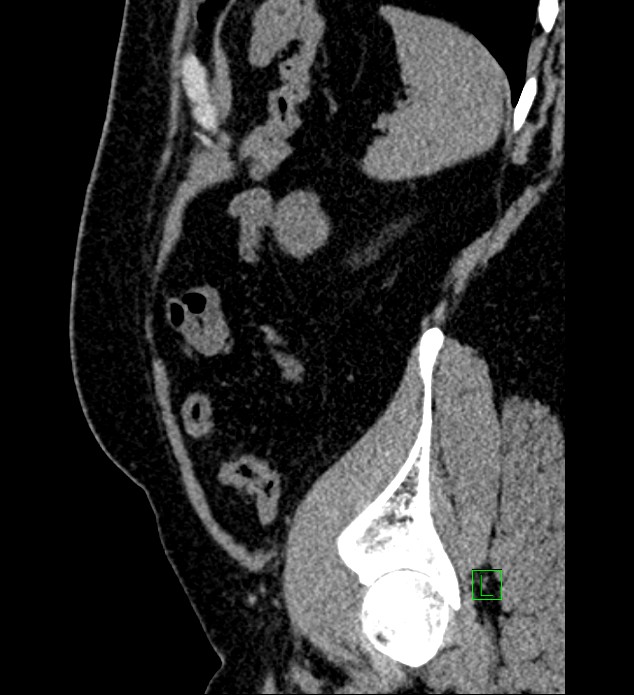 Chromophobe renal cell carcinoma (Radiopaedia 84286-99573 C 28).jpg