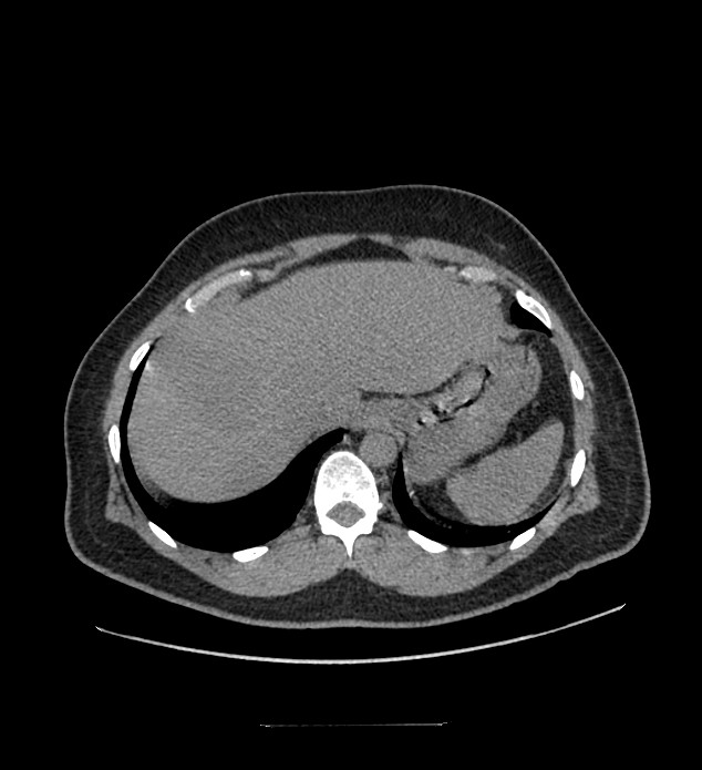 Chromophobe renal cell carcinoma (Radiopaedia 84337-99644 Axial non-contrast 14).jpg