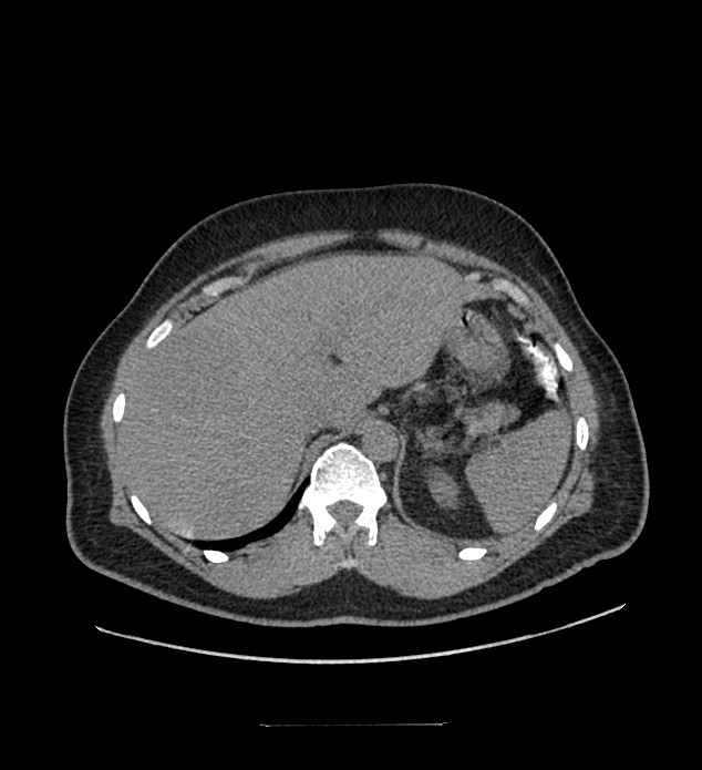 Chromophobe renal cell carcinoma (Radiopaedia 84337-99644 Axial non-contrast 20).jpg