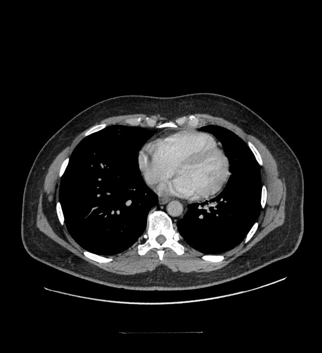 Chromophobe renal cell carcinoma (Radiopaedia 84337-99644 C 1).jpg