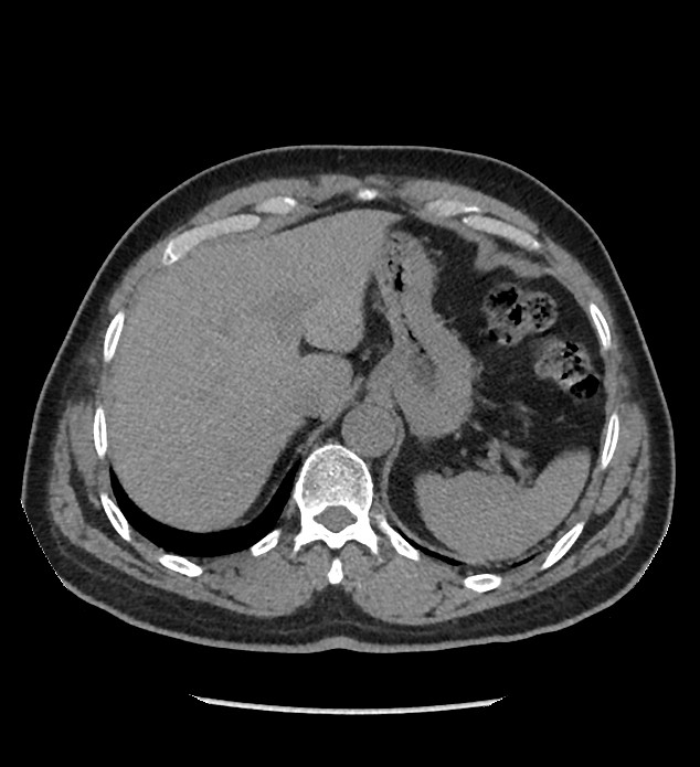 Chromophobe renal cell carcinoma (Radiopaedia 86879-103083 Axial non-contrast 9).jpg