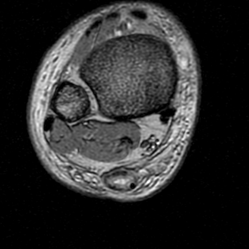 File:Chronic Achilles tendon rupture (Radiopaedia 15262-15100 Axial Gradient Echo 6).jpg