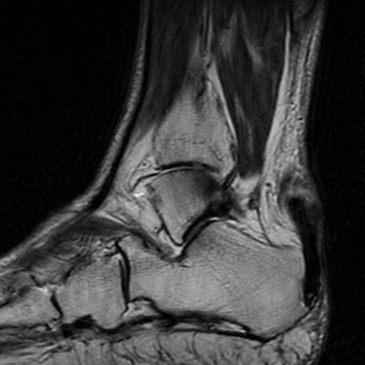 File:Chronic Achilles tendon rupture (Radiopaedia 15262-15100 Sagittal T2 4).jpg