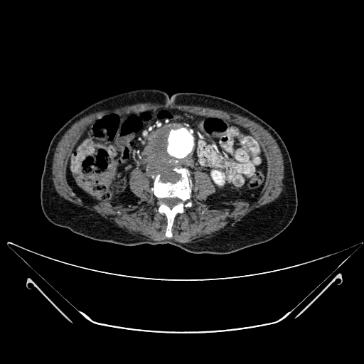 File:Chronic contained rupture of abdominal aortic aneurysm with extensive erosion of the vertebral bodies (Radiopaedia 55450-61901 A 36).jpg