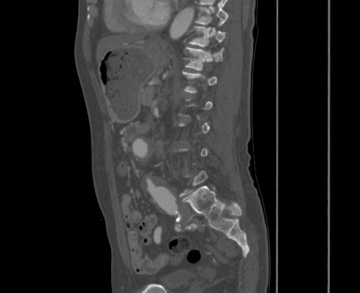 File:Chronic contained rupture of abdominal aortic aneurysm with extensive erosion of the vertebral bodies (Radiopaedia 55450-61901 Sagittal bone window 39).jpg