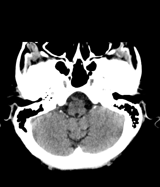 File:Chronic hypertensive encephalopathy (Radiopaedia 39993-42485 Axial non-contrast 8).png