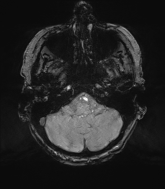 Chronic hypertensive encephalopathy (Radiopaedia 72844-83495 Axial SWI magnitude 15).png