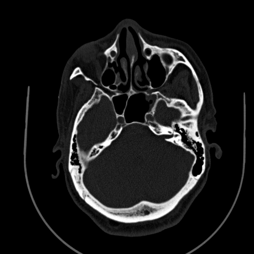 Chronic invasive fungal sinusitis (Radiopaedia 91563-109286 Axial sinus 53).jpg
