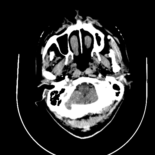 Chronic invasive fungal sinusitis (Radiopaedia 91563-109286 B 1).jpg