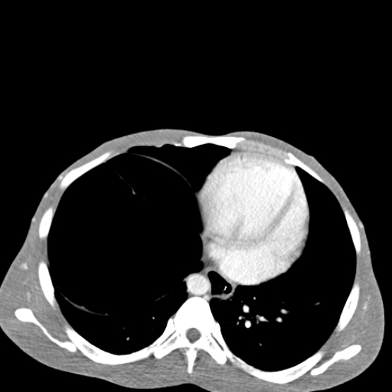 Chronic large bowel pseudo-obstruction (Radiopaedia 43181-46492 A 25).jpg