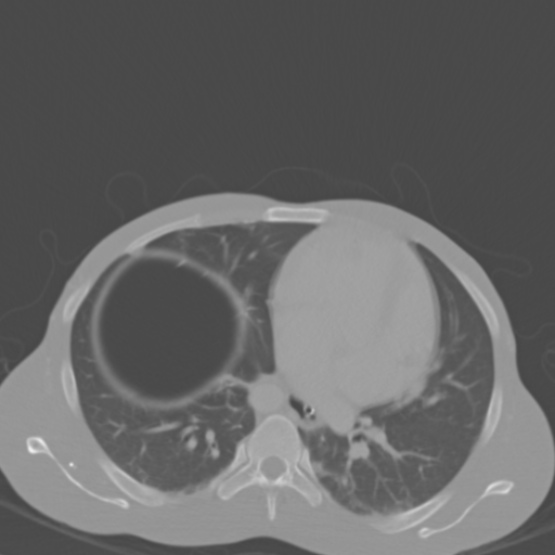 Chronic large bowel pseudo-obstruction (Radiopaedia 43181-46492 Axial bone window 18).jpg