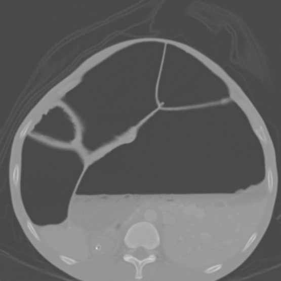 Chronic large bowel pseudo-obstruction (Radiopaedia 43181-46492 Axial bone window 62).jpg