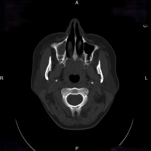 File:Chronic maxillary sinusitis with a foreign body (dental filling material) (Radiopaedia 7811-8639 Axial bone window 3).jpg