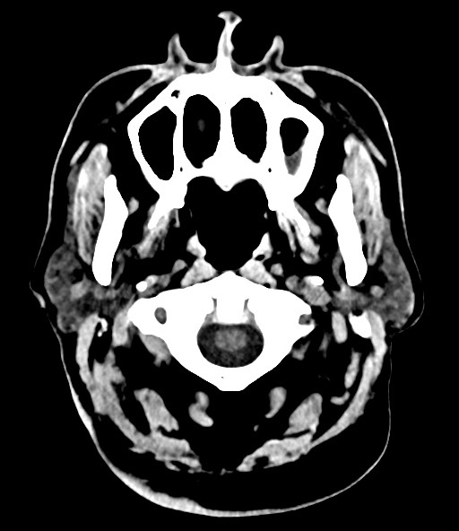 File:Chronic osteomyelitis - calvarial (severe) (Radiopaedia 69668-79616 Axial non-contrast 21).jpg