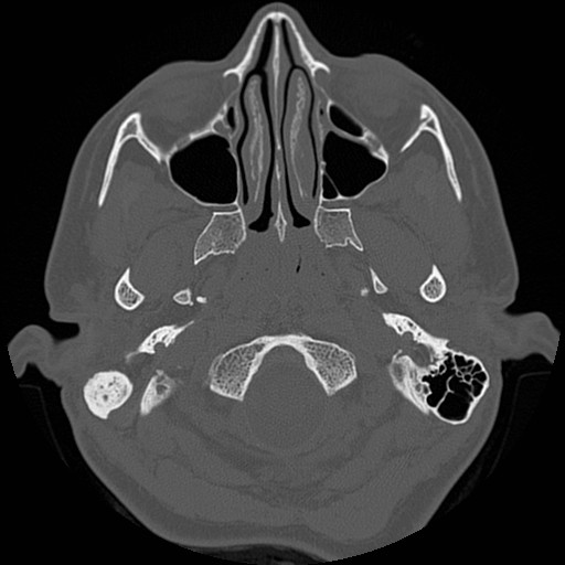 File:Chronic otomastoiditis (Radiopaedia 27138-27309 Axial bone window 3).jpg