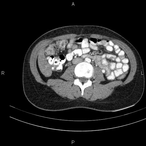 Chronic pancreatitis (Radiopaedia 64576-73450 B 91).jpg