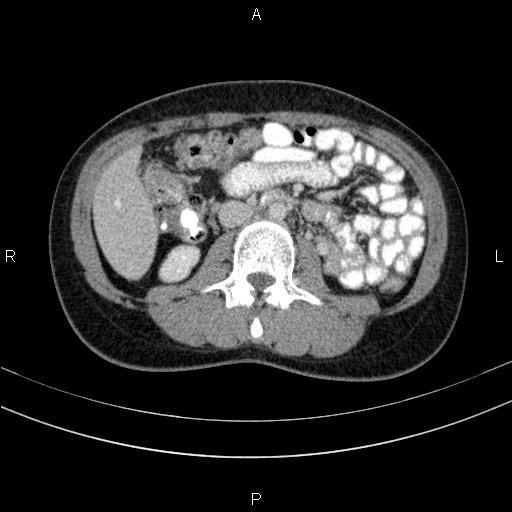Chronic pancreatitis (Radiopaedia 64576-73450 C 82).jpg