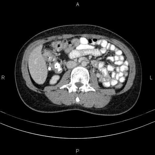 File:Chronic pancreatitis (Radiopaedia 64576-73450 C 83).jpg