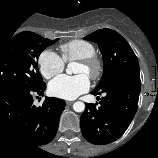 Chronic pulmonary embolism (Radiopaedia 73073-85094 Axial C+ CTPA 88).jpg