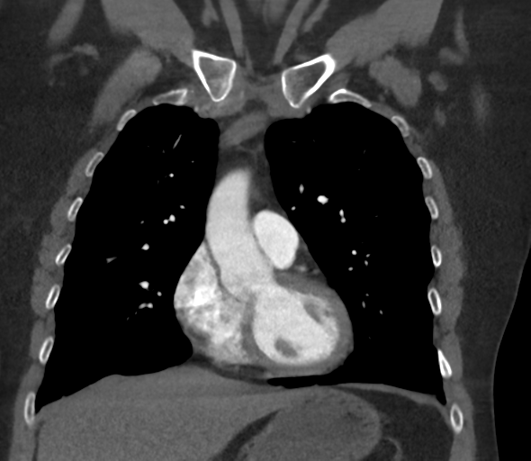 Chronic pulmonary embolus (Radiopaedia 39129-41341 Coronal C+ CTPA 34).png