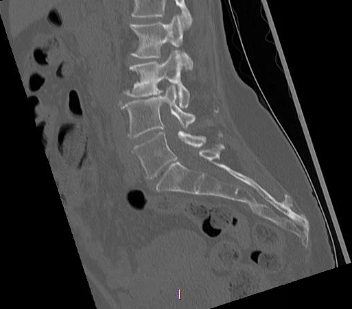 File:Chronic spinal hematoma with cauda equina syndrome (Radiopaedia 75745-88197 Sagittal bone window 12).png