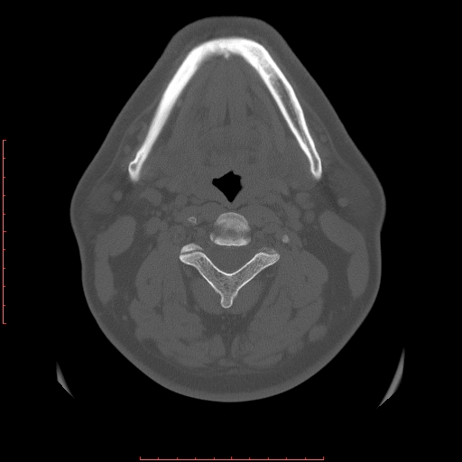Chronic submandibular sialolithiasis (Radiopaedia 69817-79814 Axial bone window 77).jpg