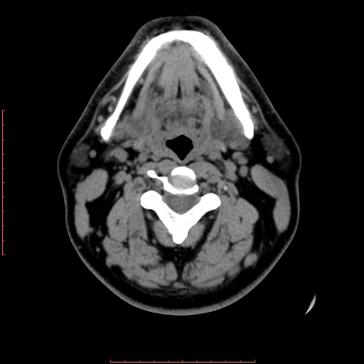 Chronic submandibular sialolithiasis (Radiopaedia 69817-79814 Axial non-contrast 111).jpg