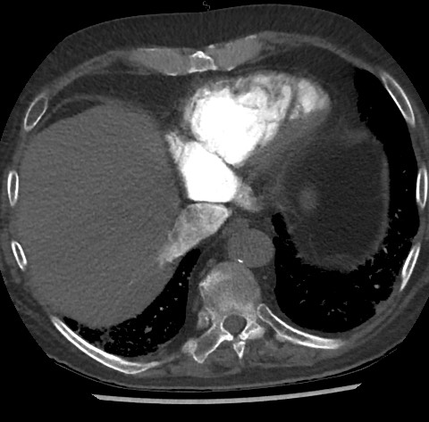 File:Chronic thromboembolic pulmonary disease (Radiopaedia 90694-108119 Axial C+ CTPA 77).jpg