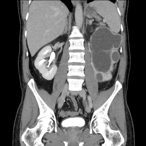 Chronic ureteropelvic junction obstruction (Radiopaedia 78365-90996 B 59).jpg
