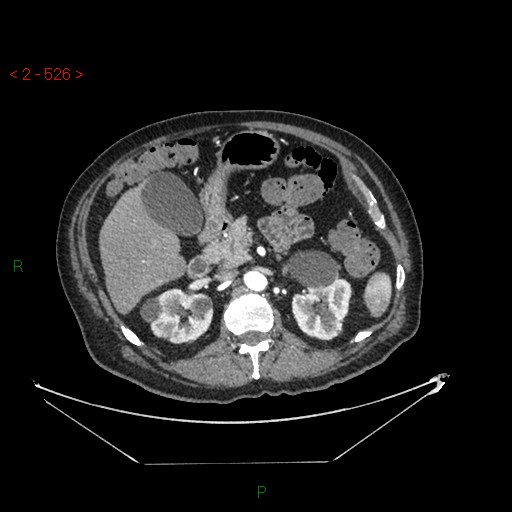Circumaortic left renal vein and doubled left renal arteries (Radiopaedia 52268-58158 A 62).jpg