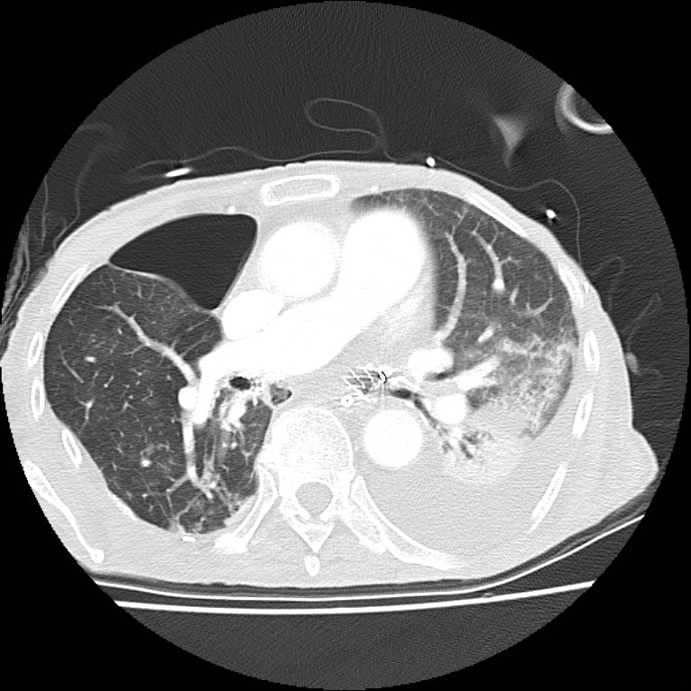 Clagett thoracotomy with bronchopleural fistula (Radiopaedia 29192-29587 Axial lung window 24).jpg