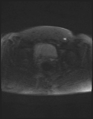 Class II Mullerian duct anomaly- unicornuate uterus with rudimentary horn and non-communicating cavity (Radiopaedia 39441-41755 Axial DWI 85).jpg