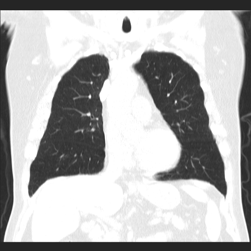 File:Classic complicated silicosis (Radiopaedia 49720-54961 Coronal lung window 23).jpg