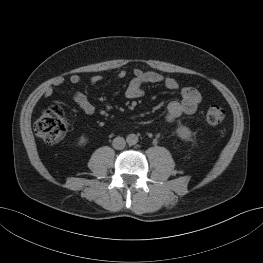 File:Clear cell renal cell carcinoma (Radiopaedia 61449-69393 Axial non-contrast 64).jpg
