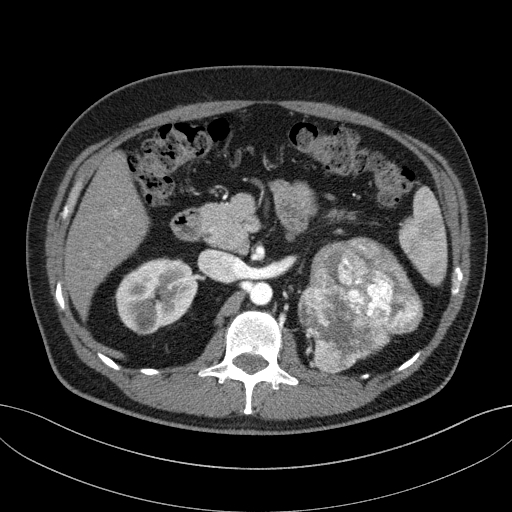 File:Clear cell renal cell carcinoma (Radiopaedia 61449-69393 B 28).jpg