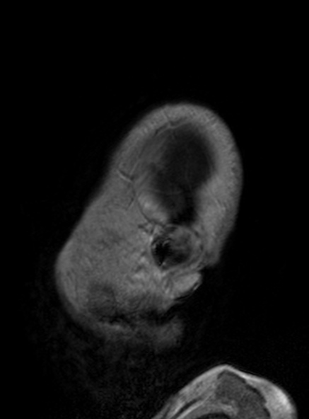 Clival meningioma (Radiopaedia 53278-59248 Sagittal T1 C+ 127).jpg