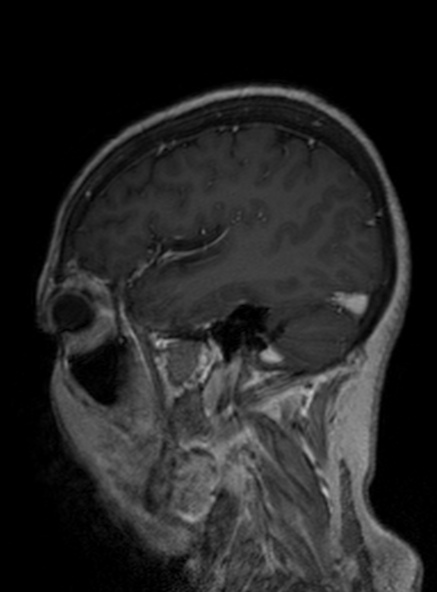 Clival meningioma (Radiopaedia 53278-59248 Sagittal T1 C+ 180).jpg