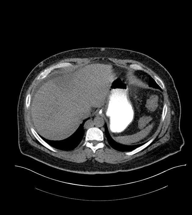 Closed-loop small bowel obstruction-internal hernia (Radiopaedia 78439-91096 Axial non-contrast 25).jpg