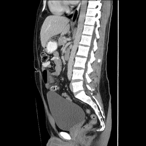 Closed-loop small bowel obstruction (Radiopaedia 73713-84509 B 90).jpg
