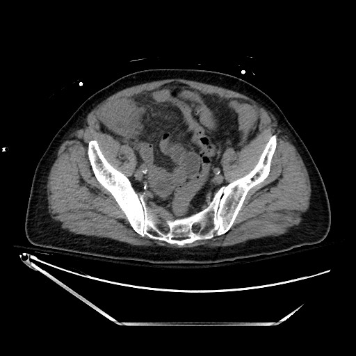 File:Closed loop obstruction due to adhesive band, resulting in small bowel ischemia and resection (Radiopaedia 83835-99023 Axial non-contrast 124).jpg