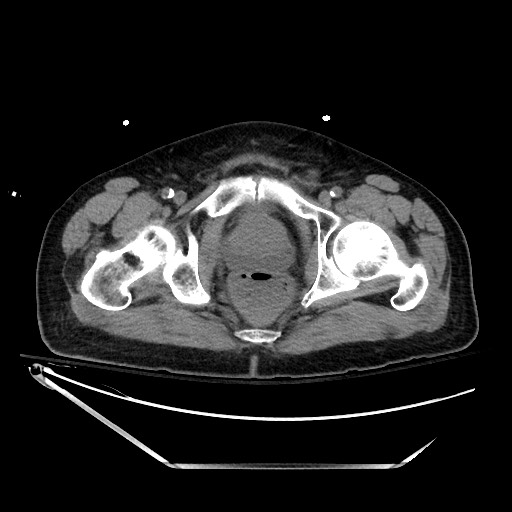 File:Closed loop obstruction due to adhesive band, resulting in small bowel ischemia and resection (Radiopaedia 83835-99023 Axial non-contrast 151).jpg