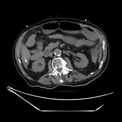 Closed loop obstruction due to adhesive band, resulting in small bowel ischemia and resection (Radiopaedia 83835-99023 Axial non-contrast 64).jpg