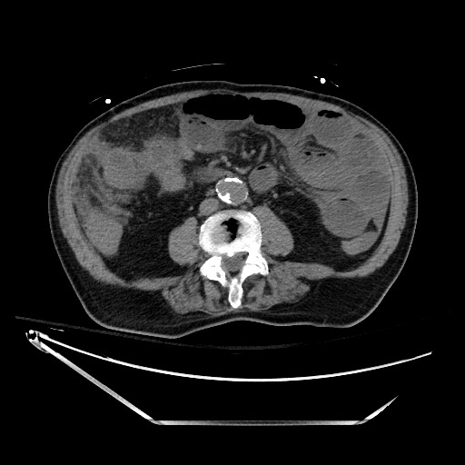 Closed loop obstruction due to adhesive band, resulting in small bowel ischemia and resection (Radiopaedia 83835-99023 Axial non-contrast 84).jpg
