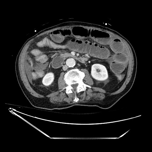Closed loop obstruction due to adhesive band, resulting in small bowel ischemia and resection (Radiopaedia 83835-99023 D 74).jpg